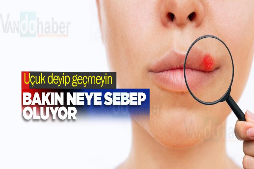 Uçuk deyip geçmeyin, bakın neye sebep oluyor