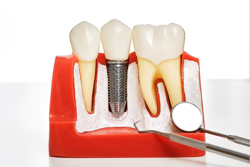 İmplant SSK kapsamına giriyor