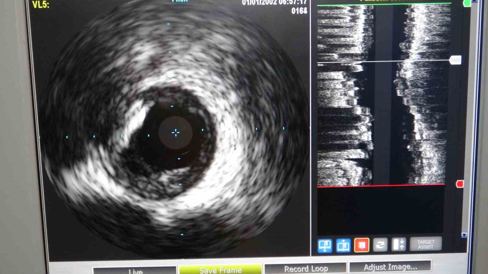 Van’da hastaneye kazandırılan IVUS cihazı hastalara umut oldu